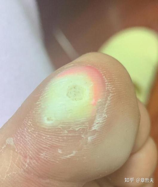 你确定脚上长的是鸡眼说不定是