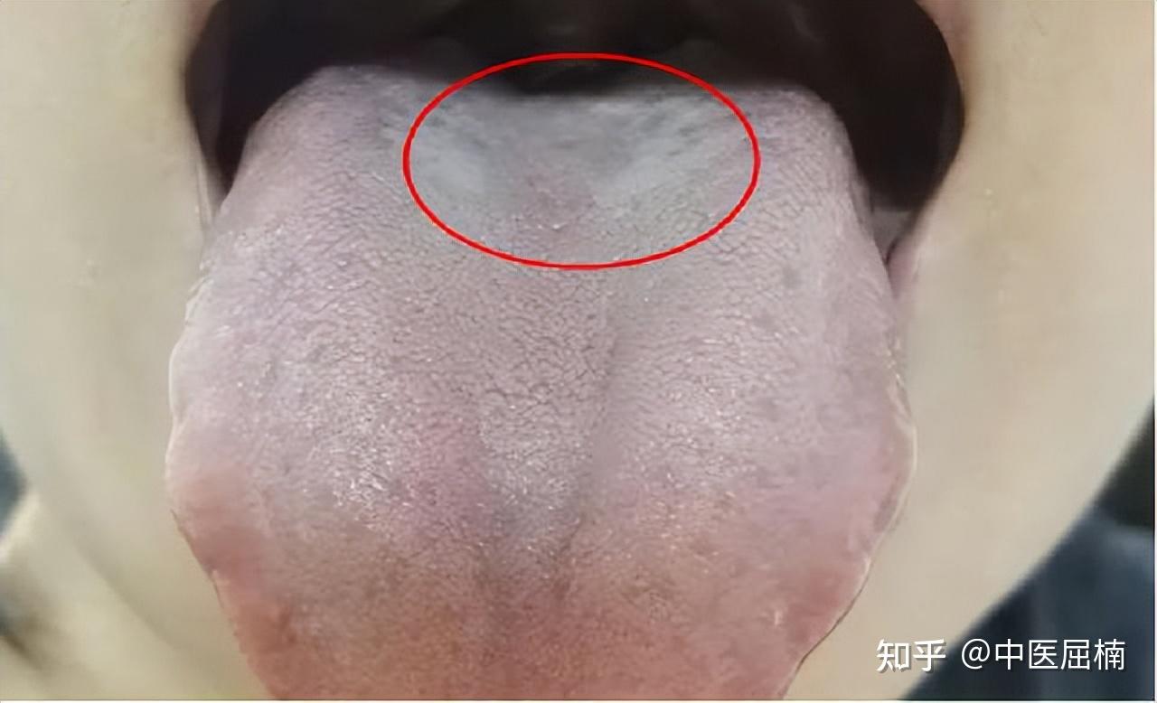 同样是肾虚,为什么舌苔不一样?屈医生分析下常见的4种肾虚舌象 - 知乎