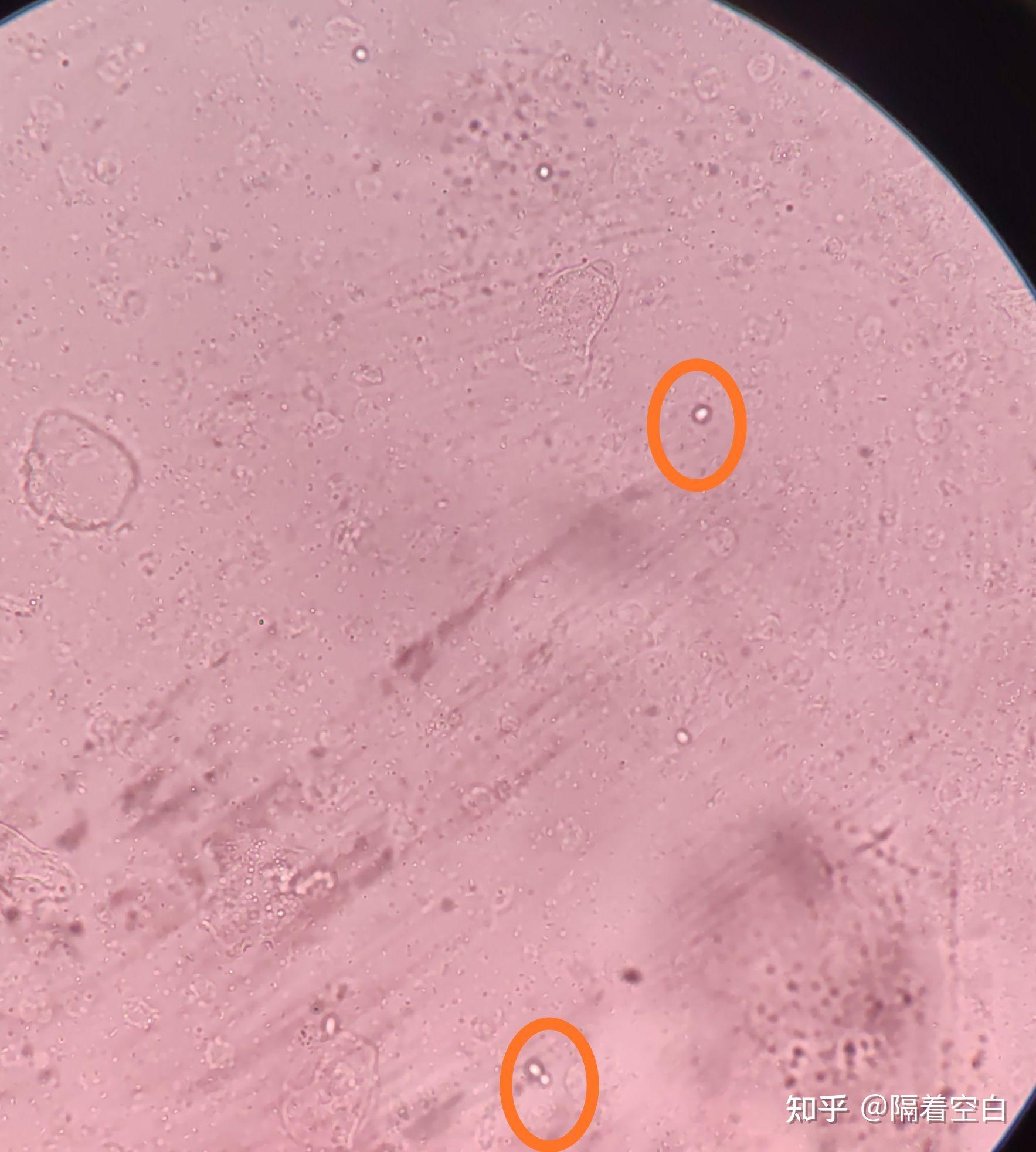 40×镜下念珠菌(少量)图五:40×镜下大量念珠菌酵母样霉菌多数有菌丝