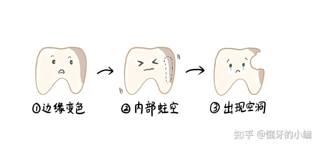 口腔刺客——邻面龋 - 知乎