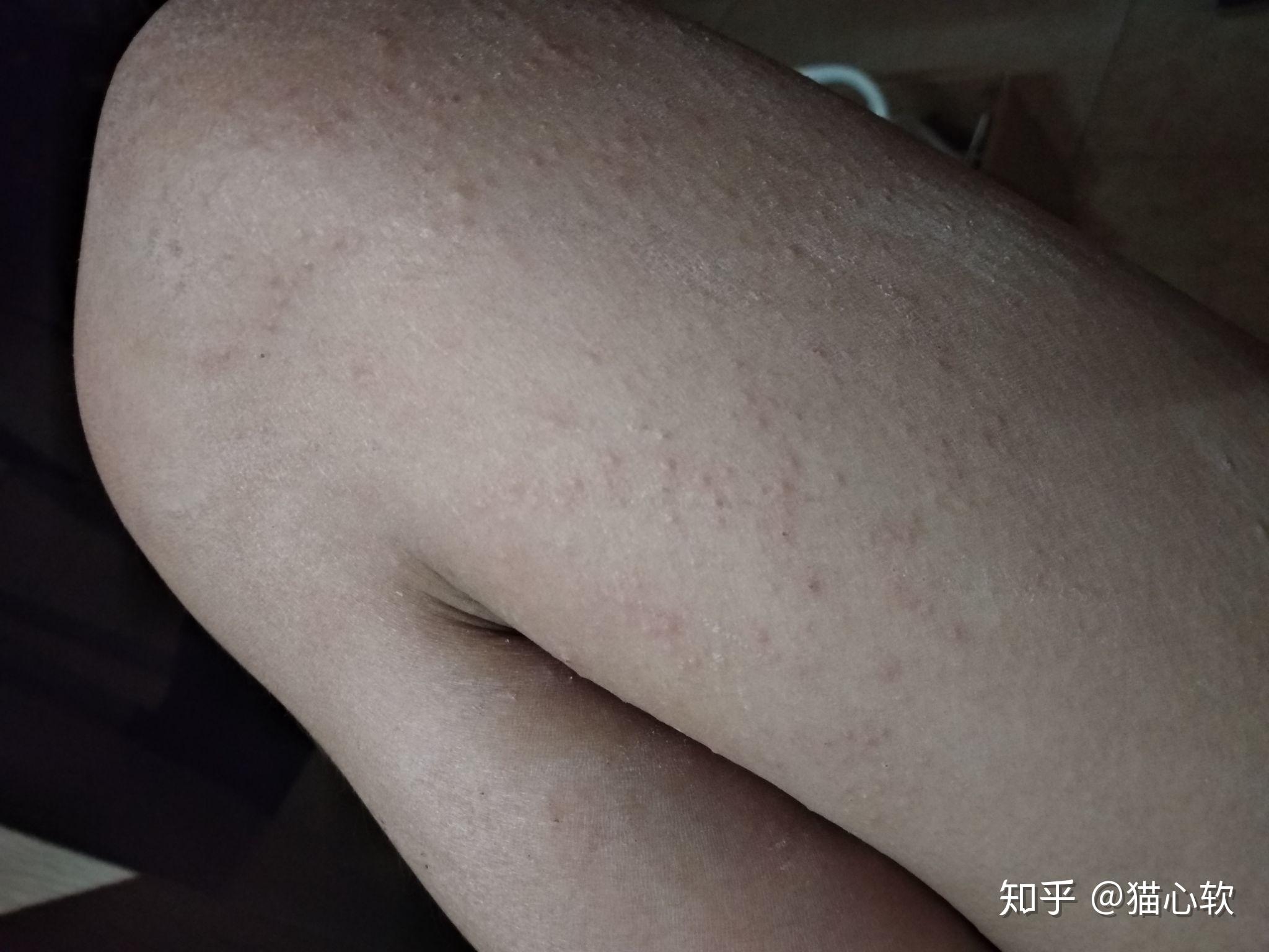 过敏性荨麻疹的症状「过敏性荨麻疹的症状和治疗氯雷他定多久」