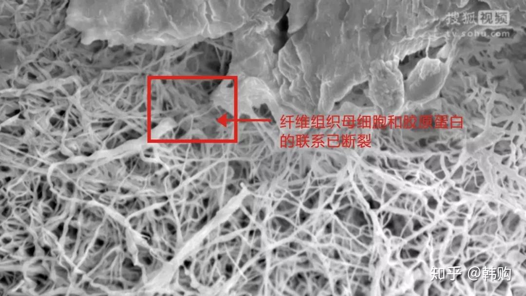 皮肤内弹性纤维断裂图图片