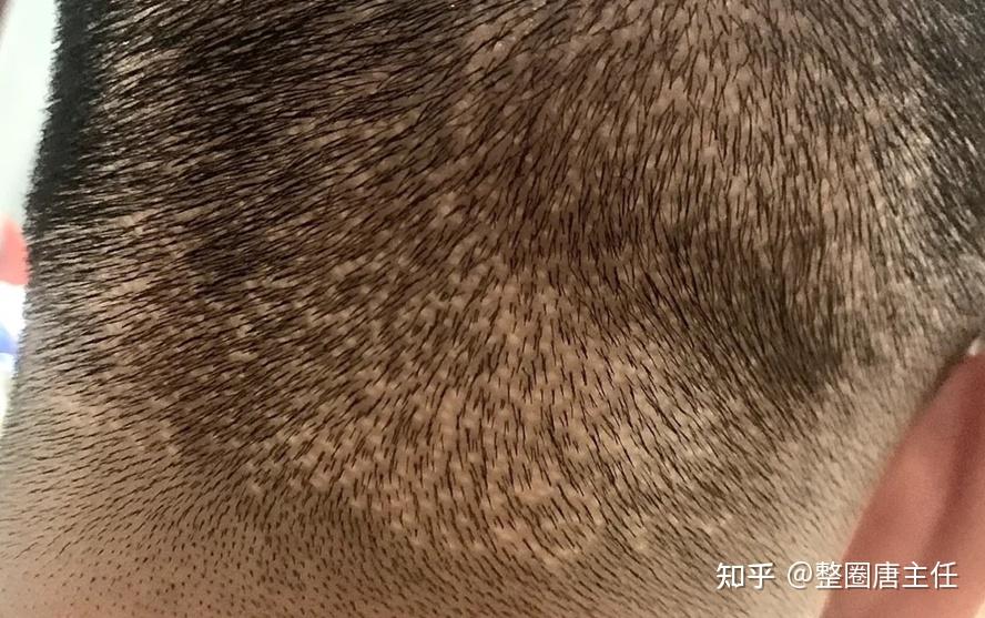 ash植发(植发方式有几种)