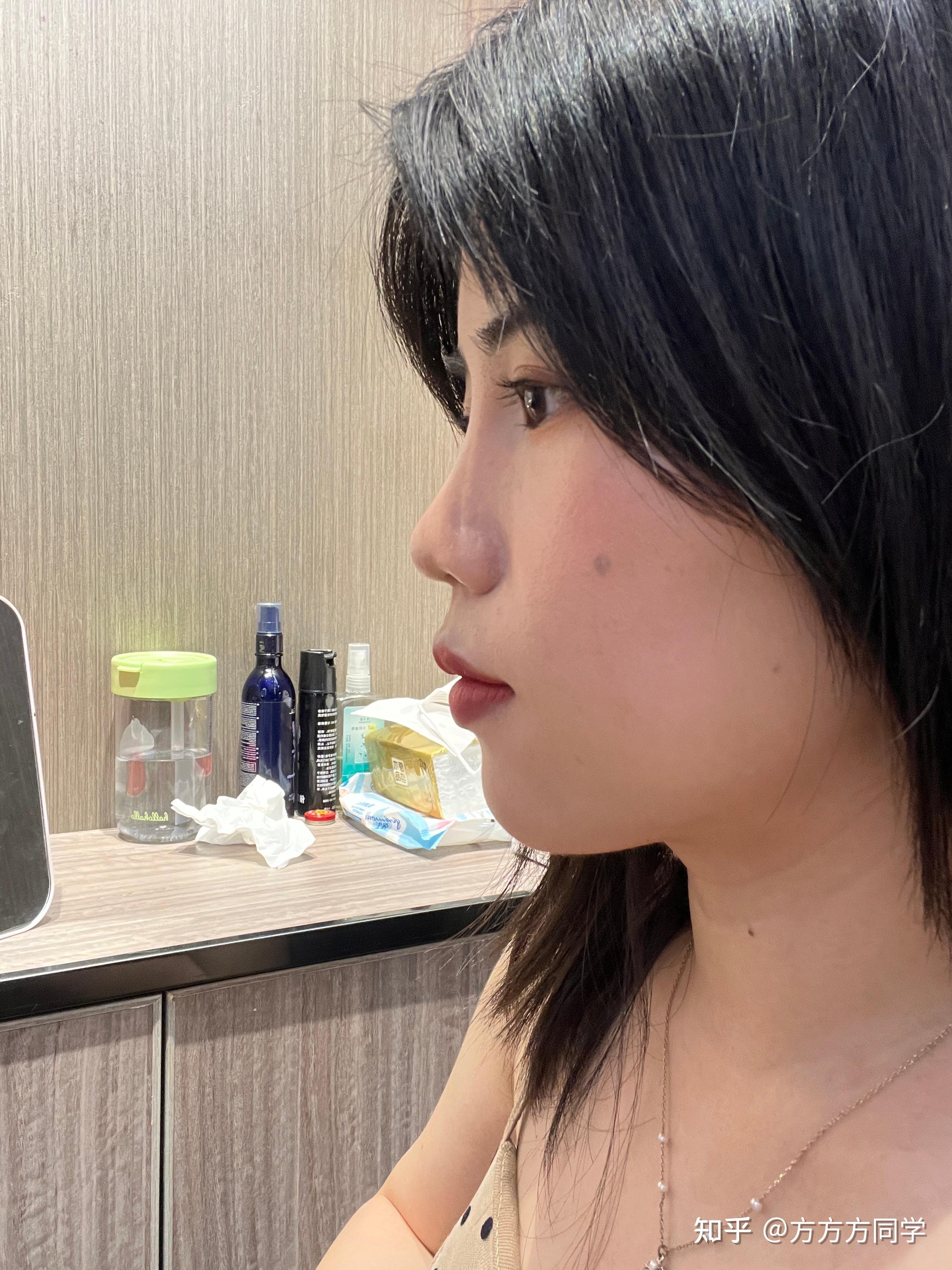 关于成年人牙齿矫正(骨性凸嘴)已拆牙套 - 知乎