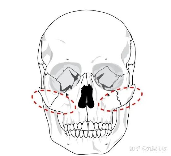 九院韦敏说,颧弓颧骨内推能让脸小多少? - 知乎