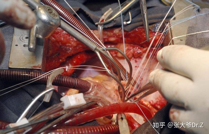 谈谈您身边的二尖瓣置换术 - 知乎