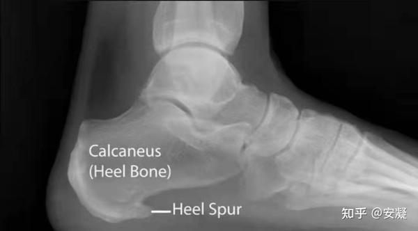 bone-spurs