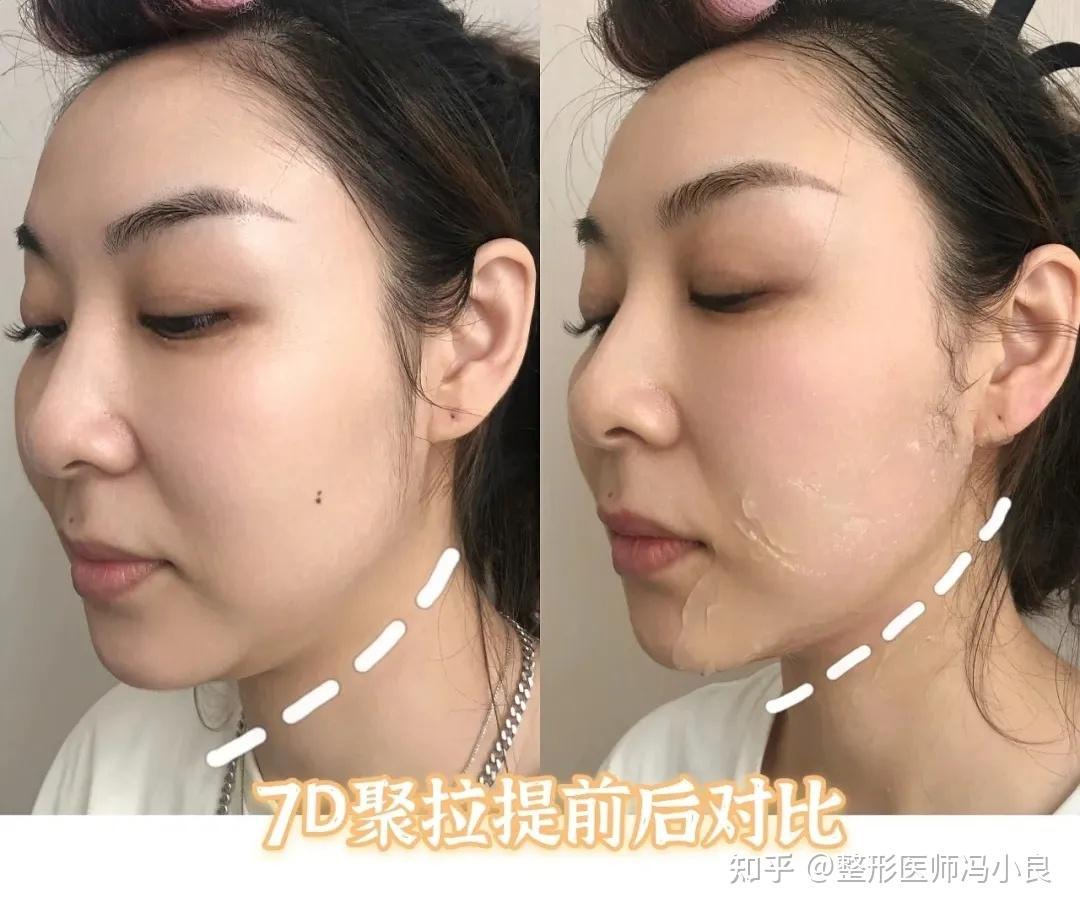 选择7d聚拉提十大理由有你心动的吗