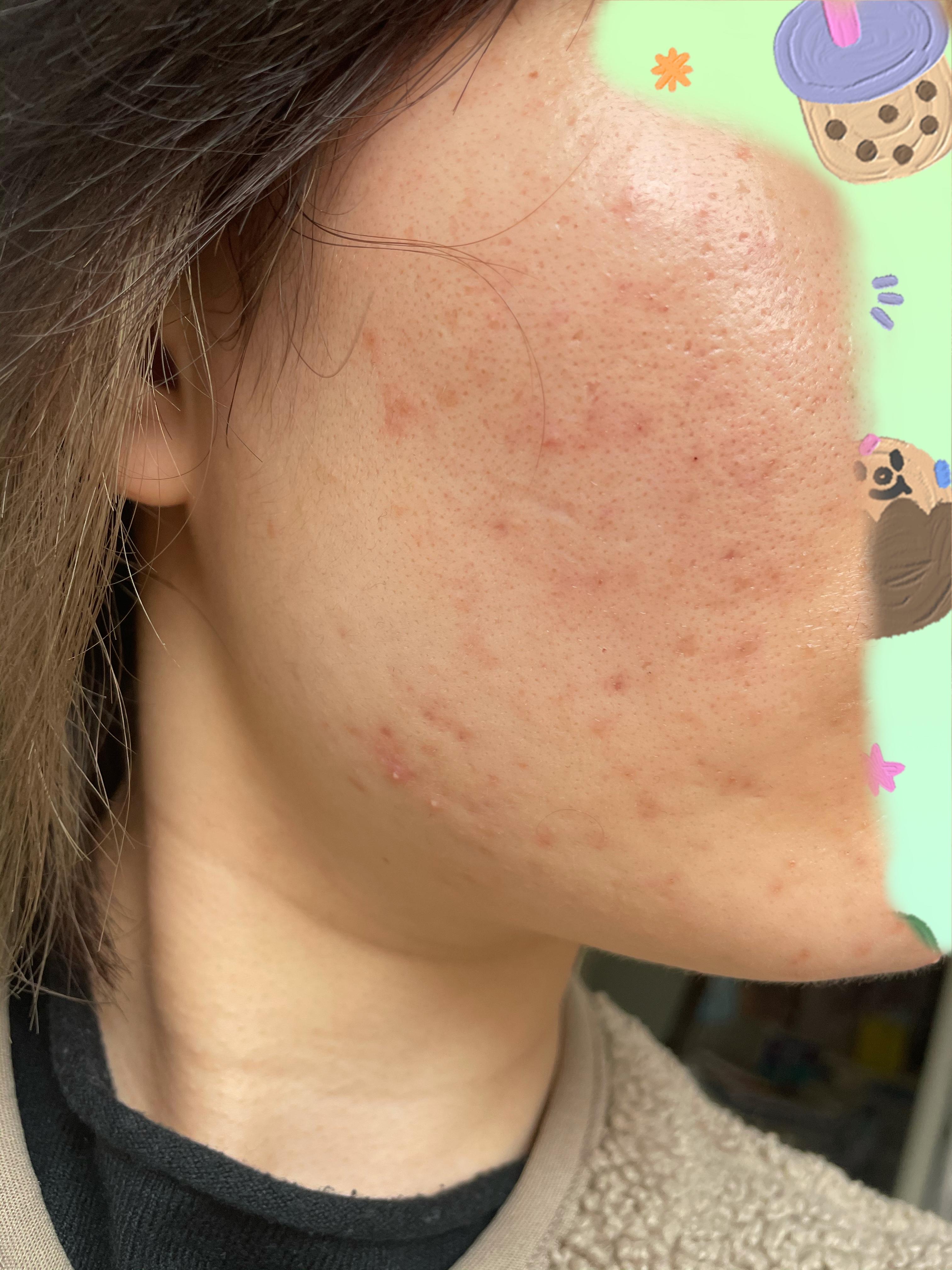 医院刷酸全程记录(持续更新)