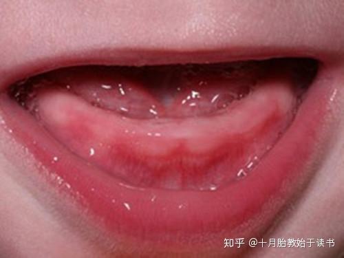 4,牙龈发炎根据我的经验,牙龈发炎是宝宝出牙的唯一确定症状