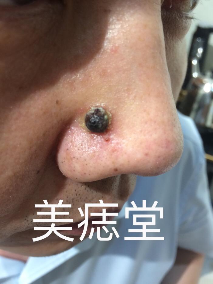 愿您痣去福来相貌庄严盛龙广场骡马市美痣堂欢迎你