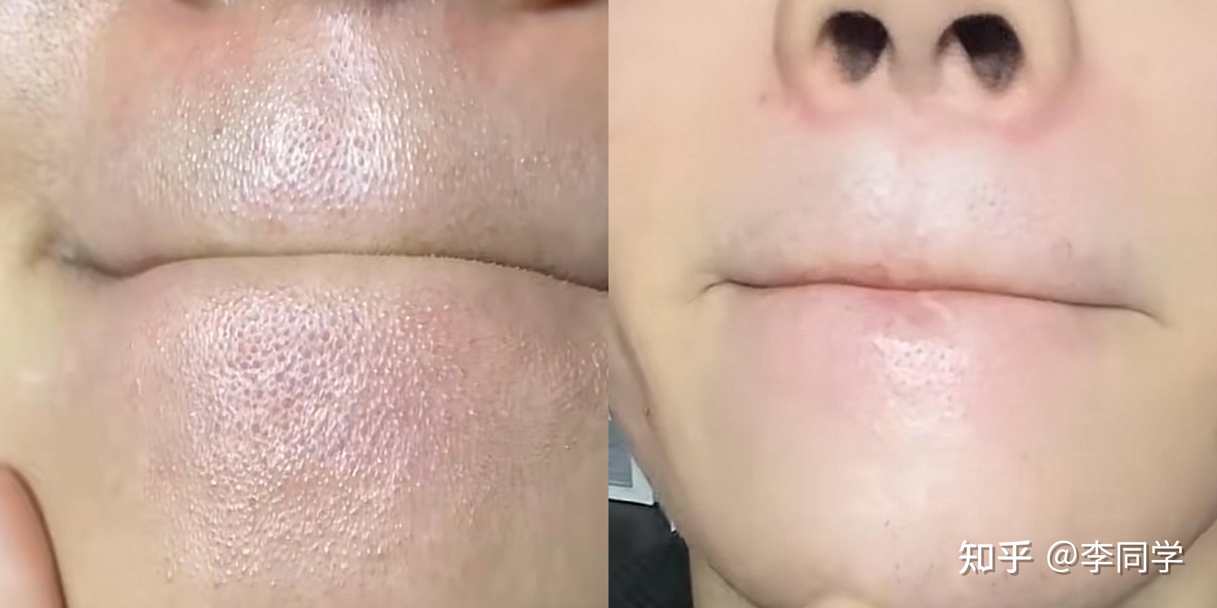 肾炎会导致下巴上经常长粉刺一般下巴长闭口的常伴有月经不调等总之