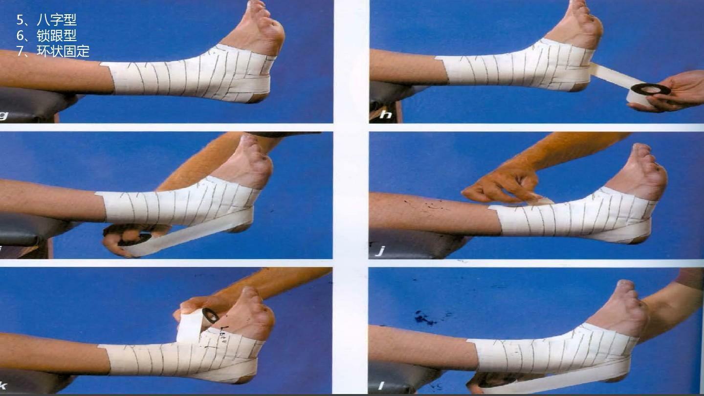 踝关节扭伤就急处理