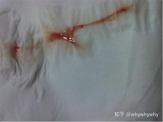 教你怎样看白带带图慎入