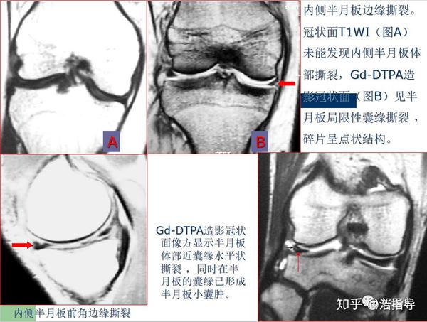 膝关节半月板损伤核磁诊断要点详解与治疗分析 知乎