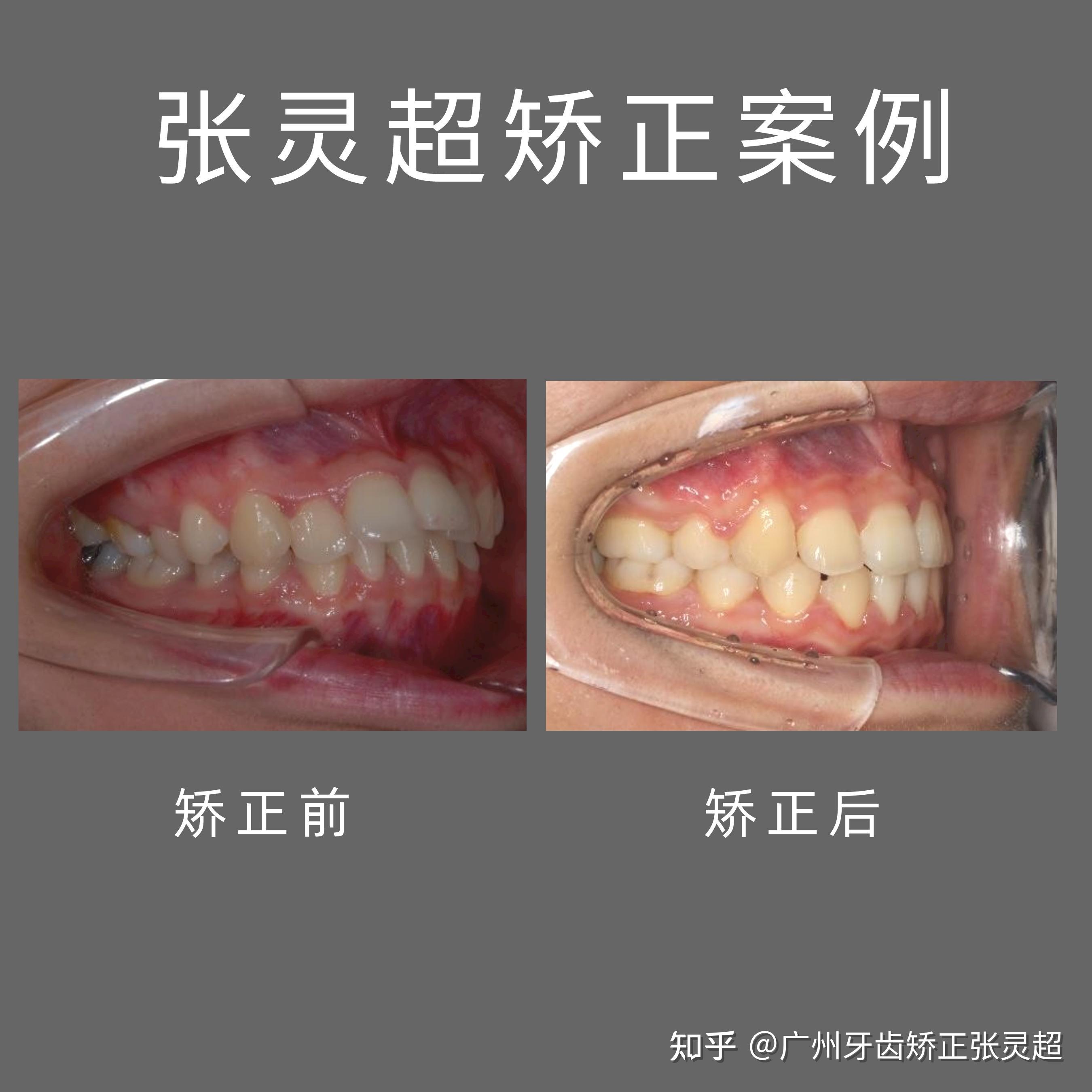 广州牙齿矫正(正畸)|近期,深覆合深覆盖合集 - 知乎