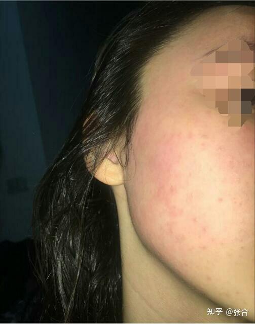 角质层薄到底该怎么办皮肤泛红干痒