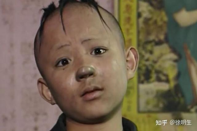 3岁儿童植发(小孩植发对孩子发育有影响吗?)
