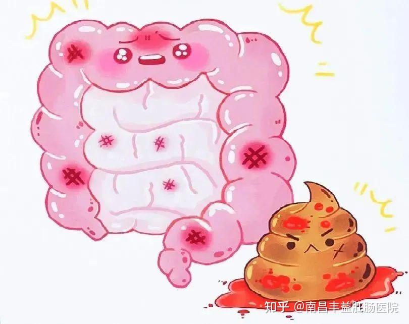 便血了,是痔疮还是癌?出现这3个症状,可能需要做肠镜!! - 知乎
