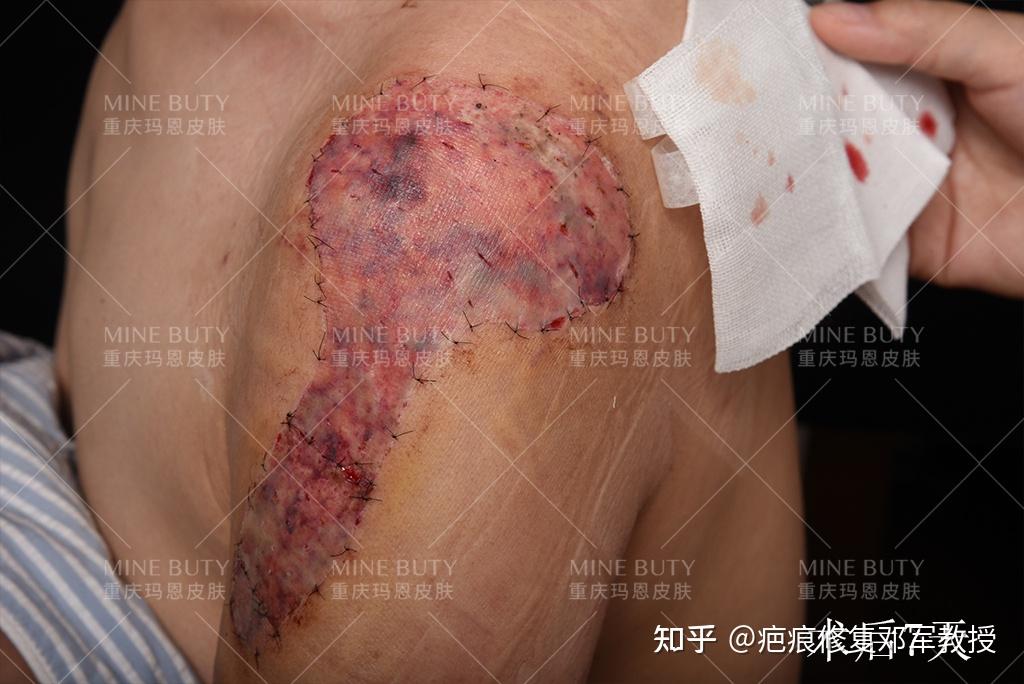 大面积的疤痕如果采用超微创植皮手术,术后不会增加疤痕部位的的张力