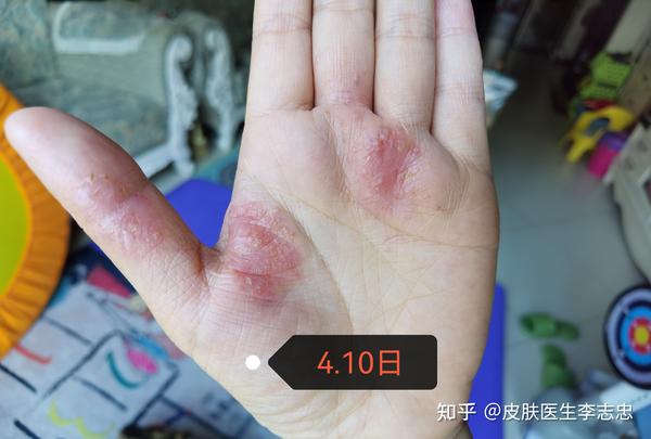 中医古籍对掌跖脓疱病(瘑疮)的认识和解析! - 知乎