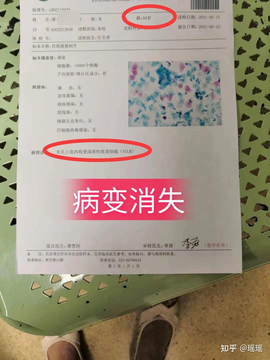 54岁大姐历经四年hpv终于转阴