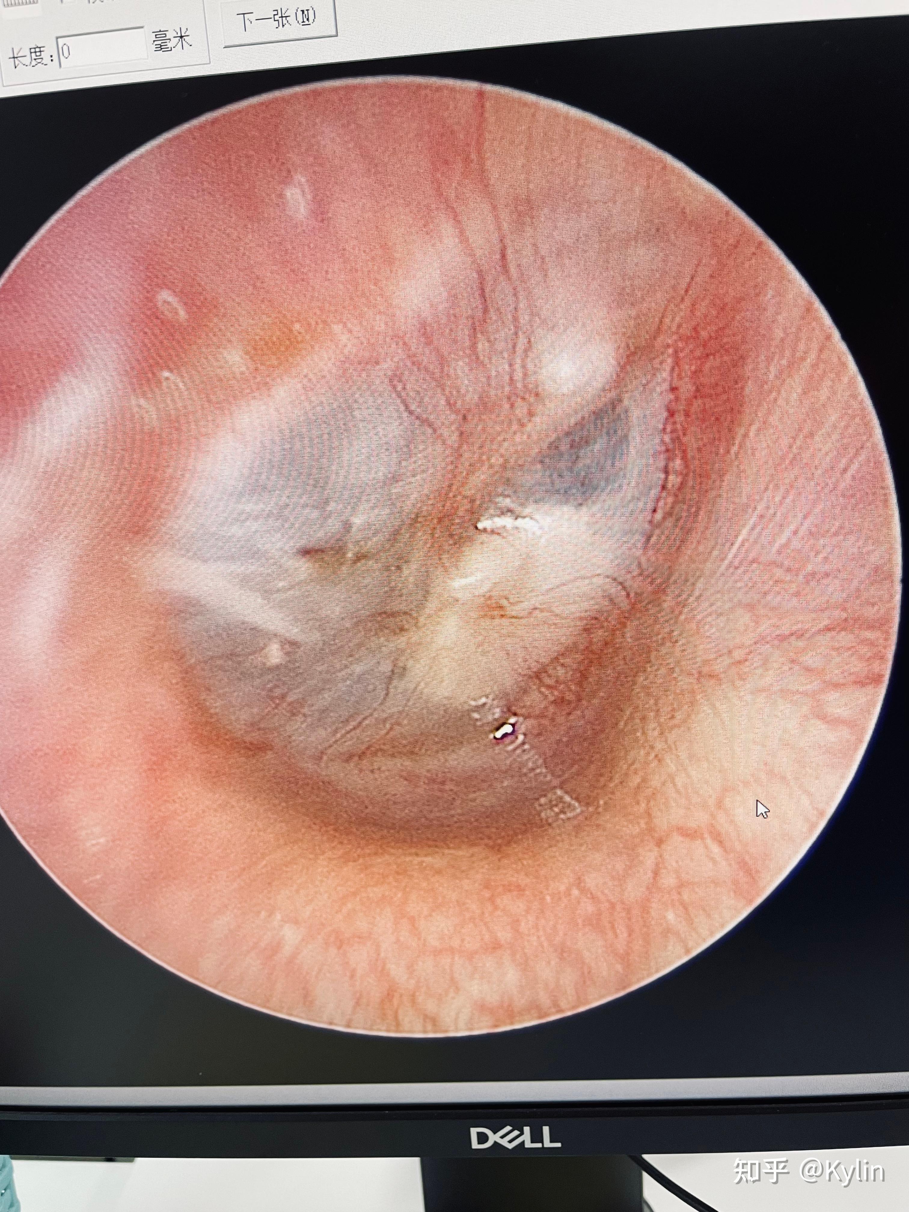 耳膜穿孔修复手术全过程记录第五天