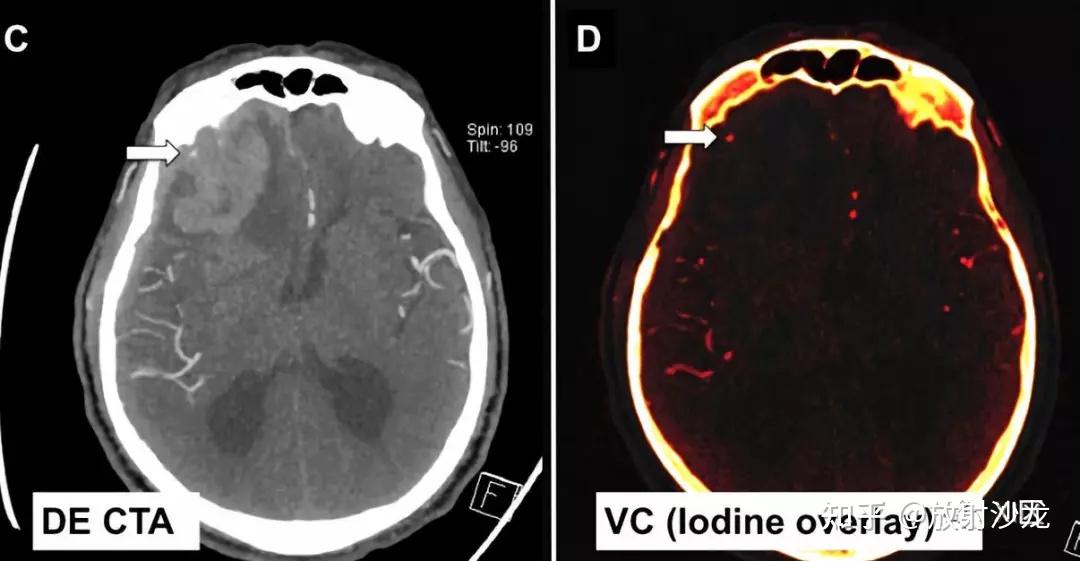 ct圖像中腦出血血腫擴大的十個徵象(下) - 知乎