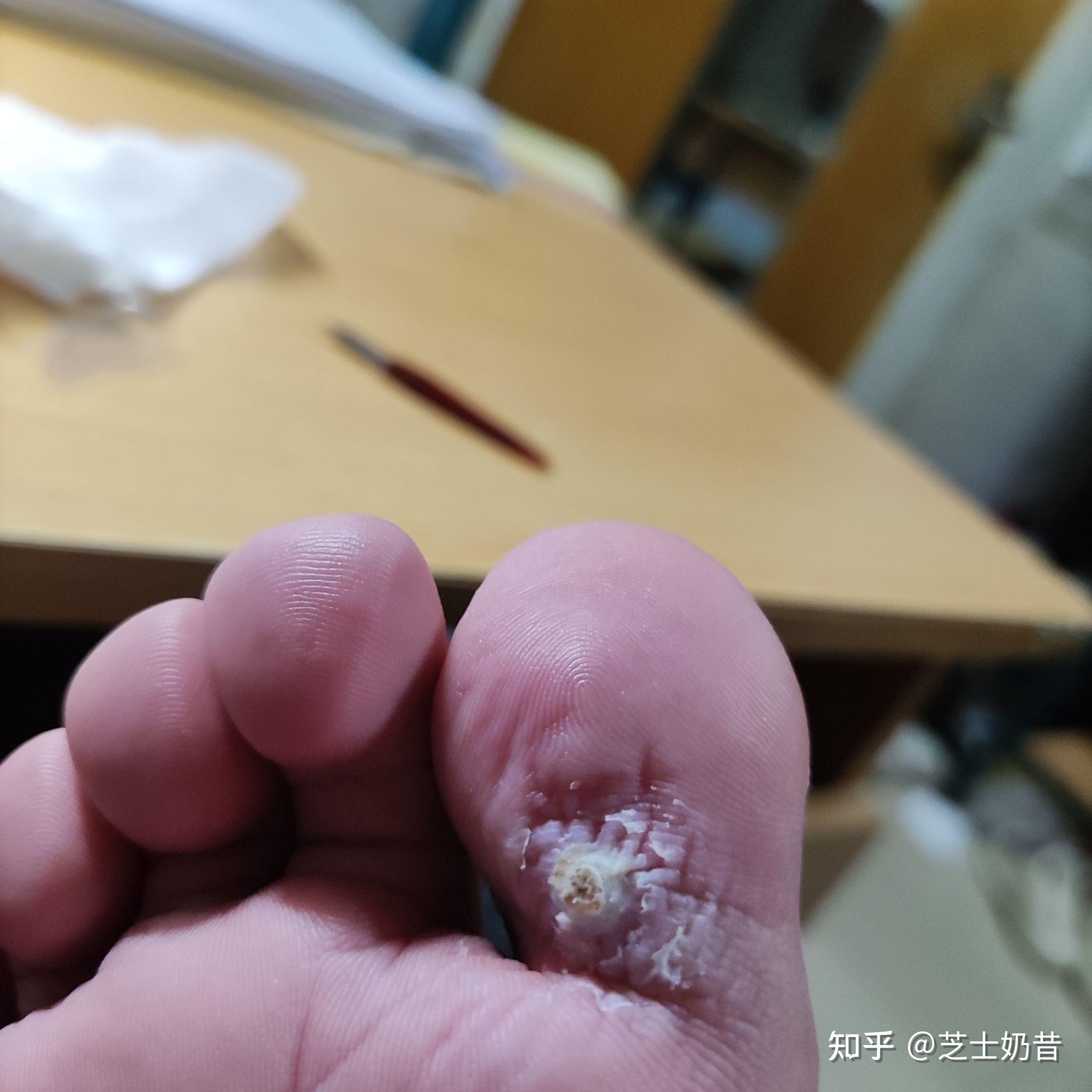 蹠疣的自治療過程