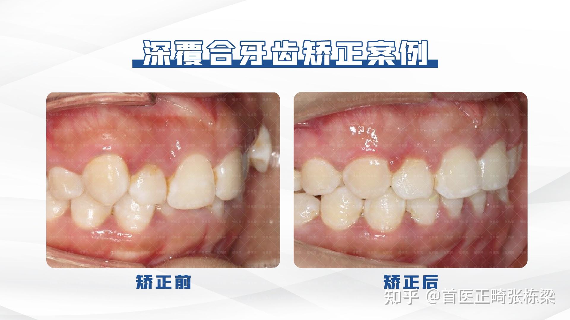 北京牙齿正畸 | 不拔牙矫正改善深覆合，实现健康与美观的双赢！ - 知乎