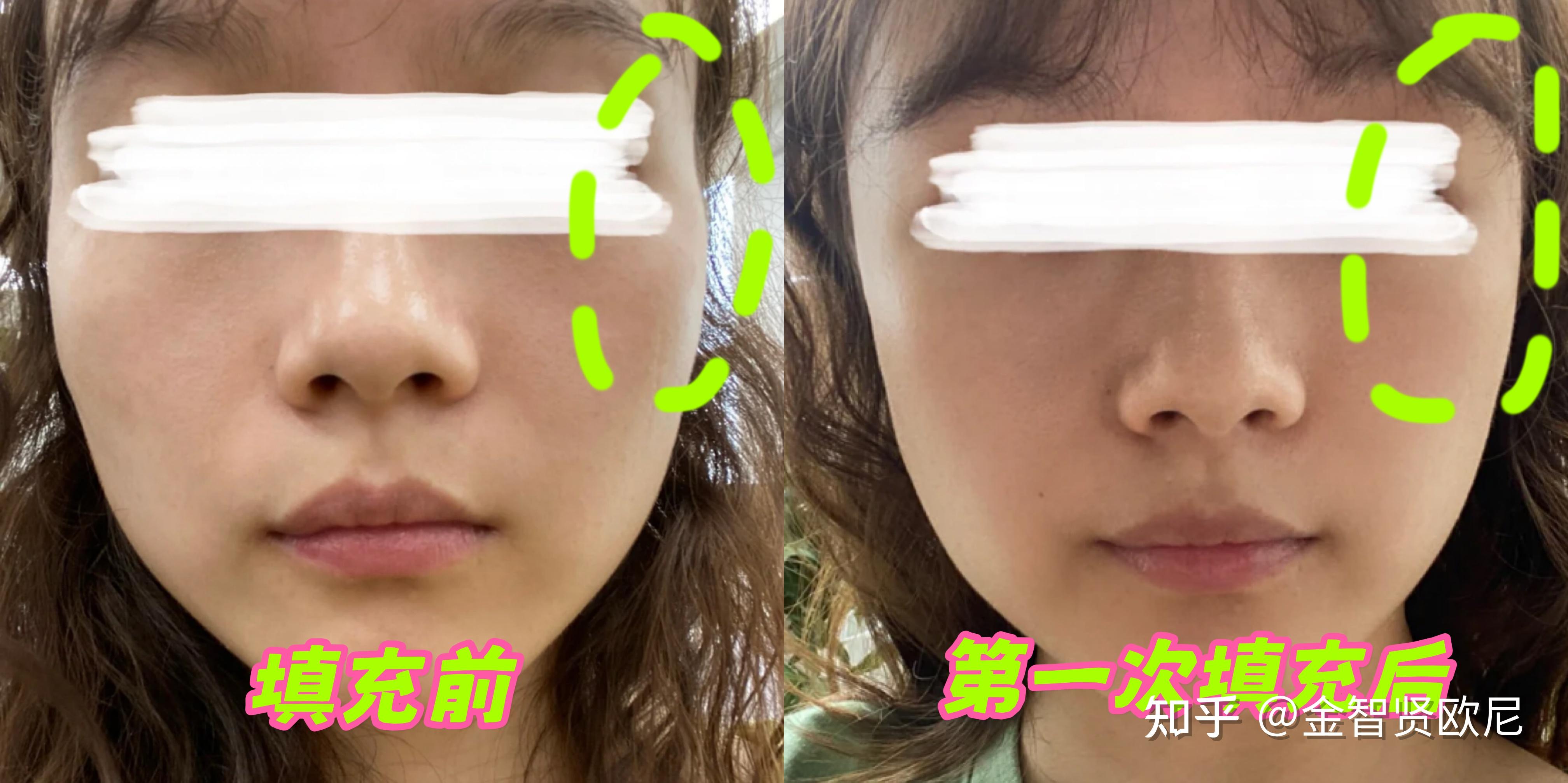 童颜针到底是什么？可解决什么面部问题？有哪些注意事项？