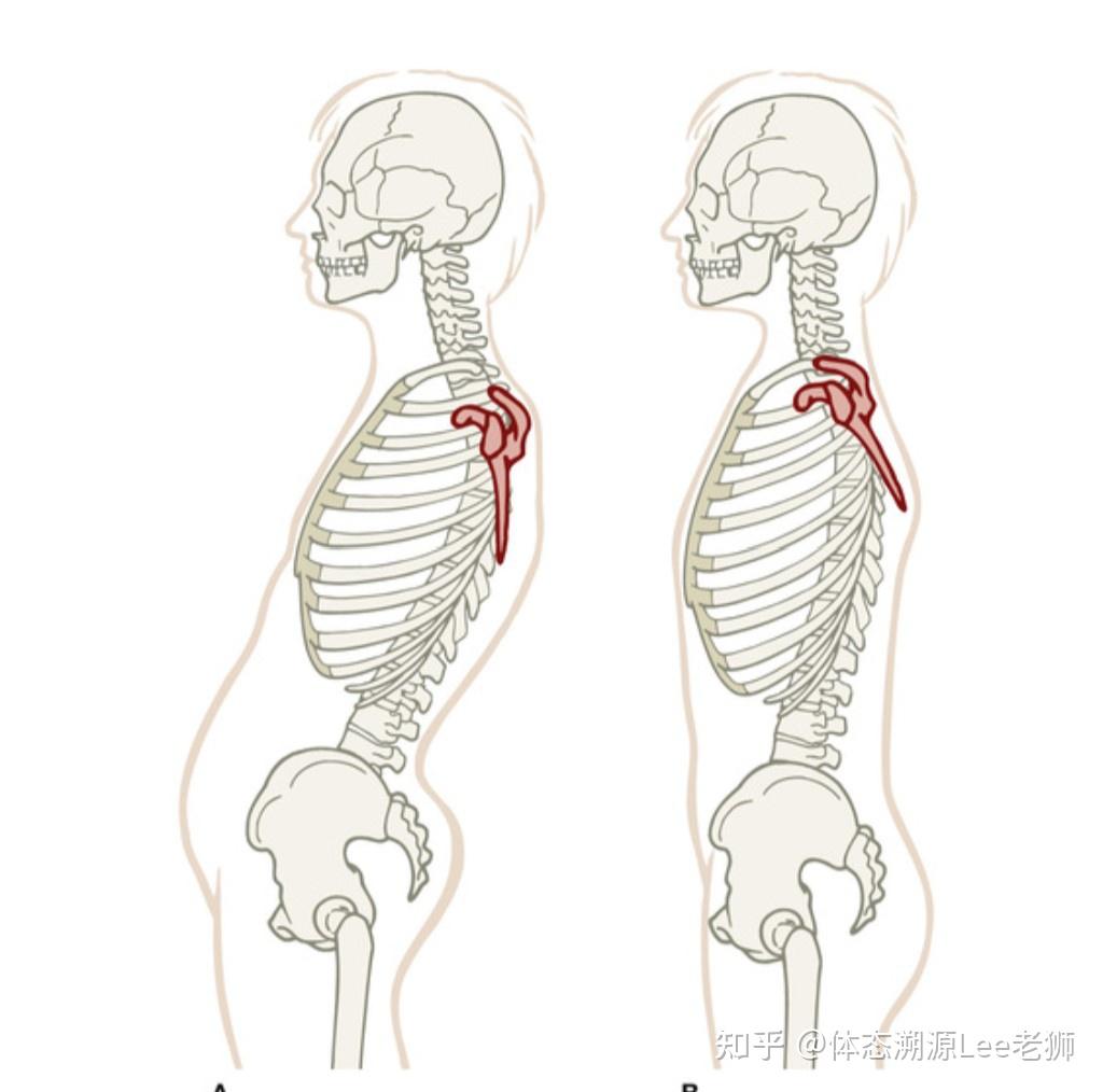 为什么会o型腿图片