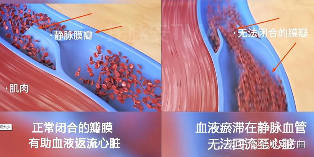 精索静脉曲张导致阴囊下坠睾丸疼痛怎么办? - 知乎
