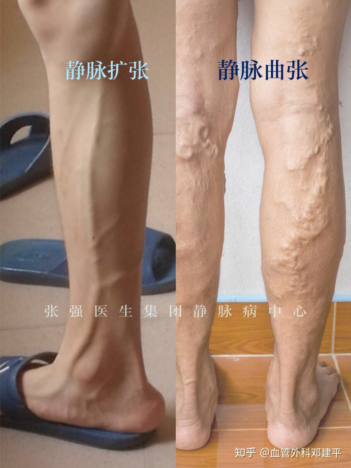 这个是静脉曲张还是普通的血管粗大? - 知乎