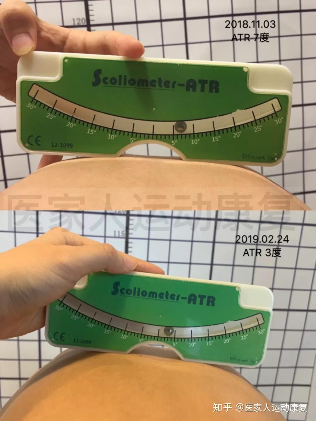 体表前后治疗对比图体表前后治疗对比图剃刀背治疗对比图康复前后对比