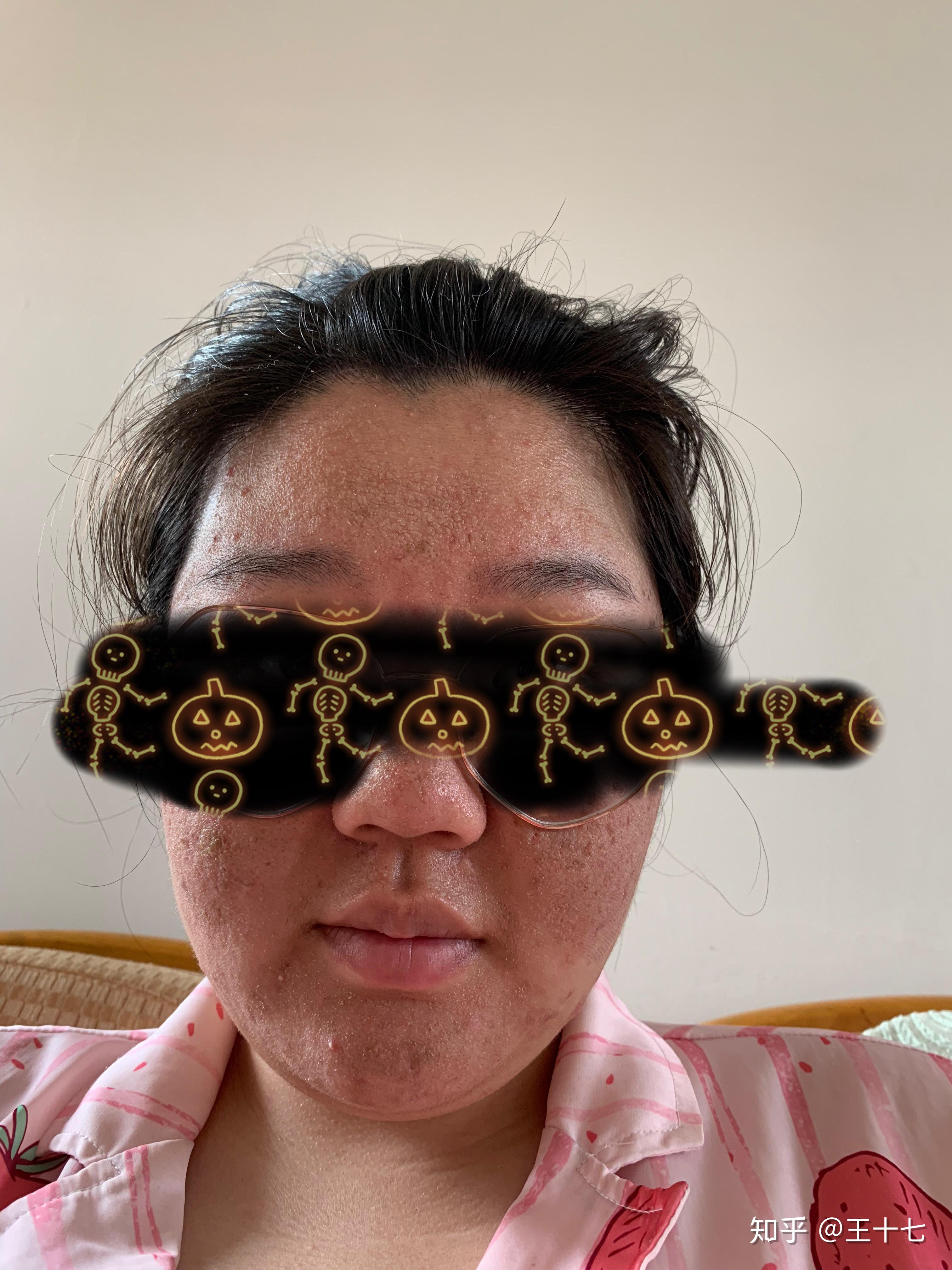 点阵激光VS陈年痘坑