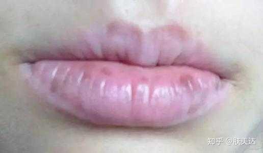 嘴唇暗沉 有黑斑 是什么原因 如何改善 知乎