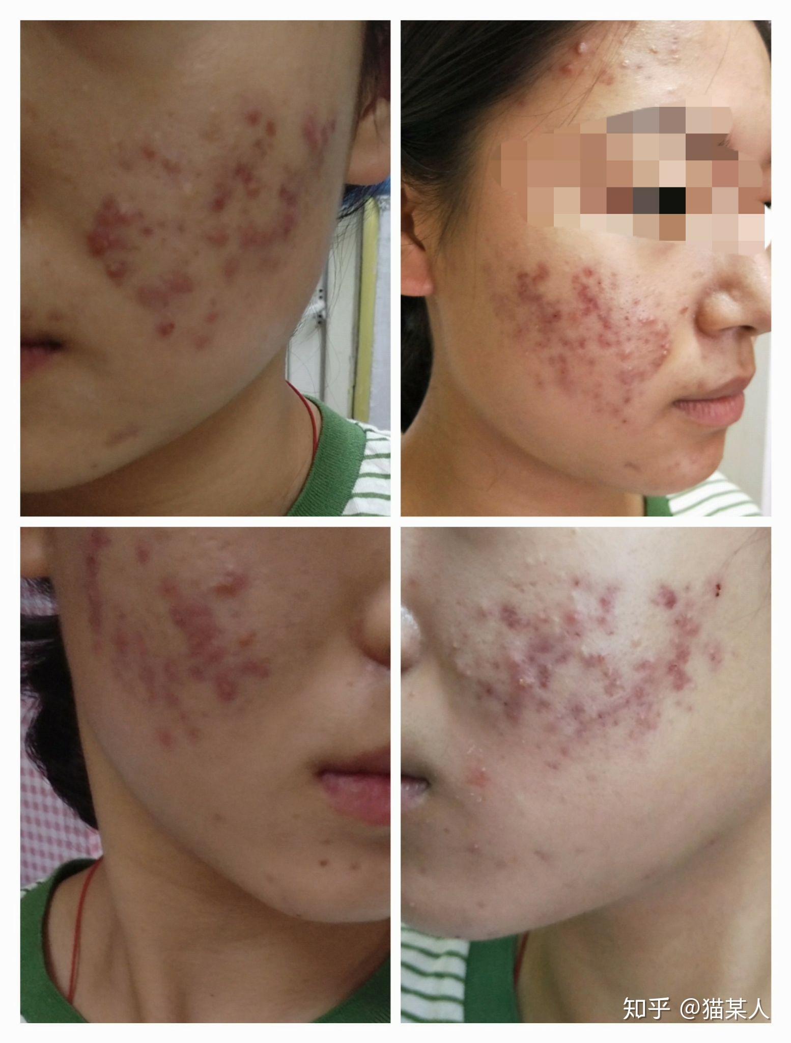 记录治疗痘痘的过程