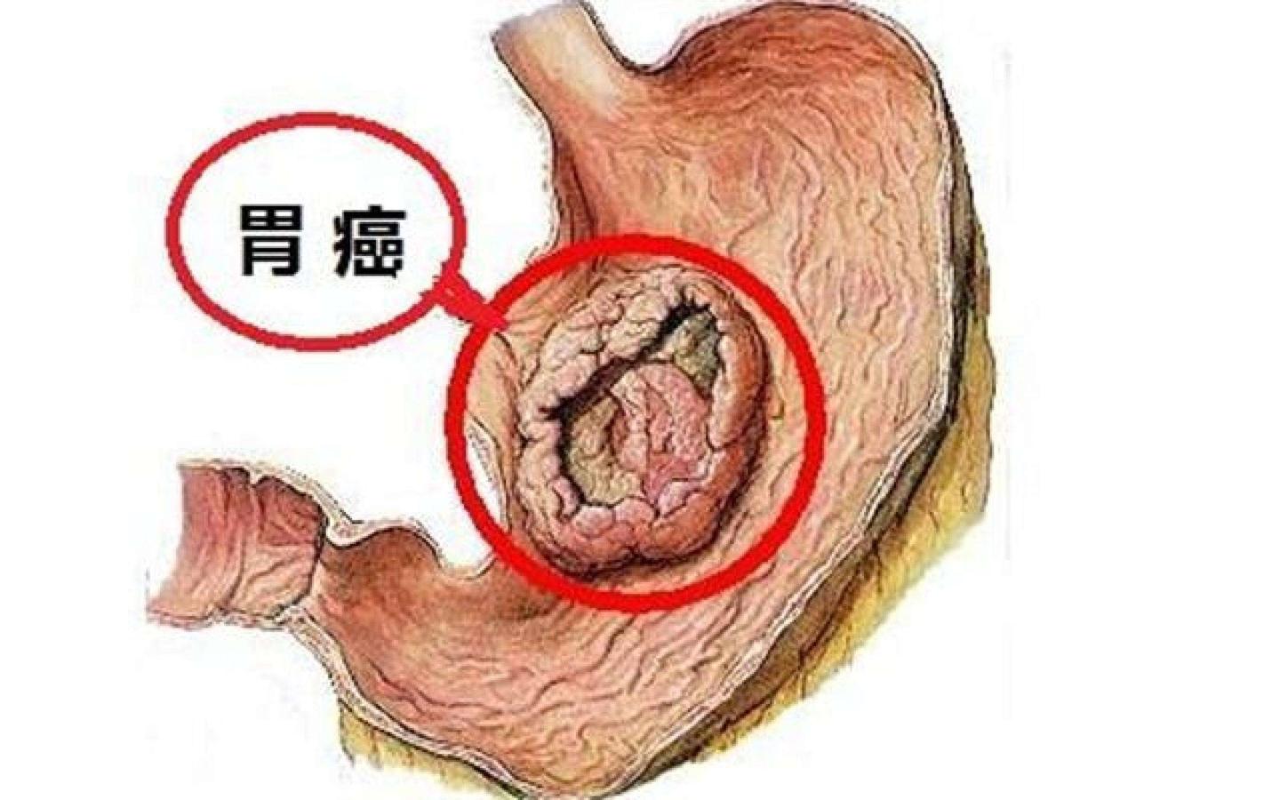 胃癌靶向治疗的研究进展 知乎 胃癌靶向治疗的研究进展 知乎