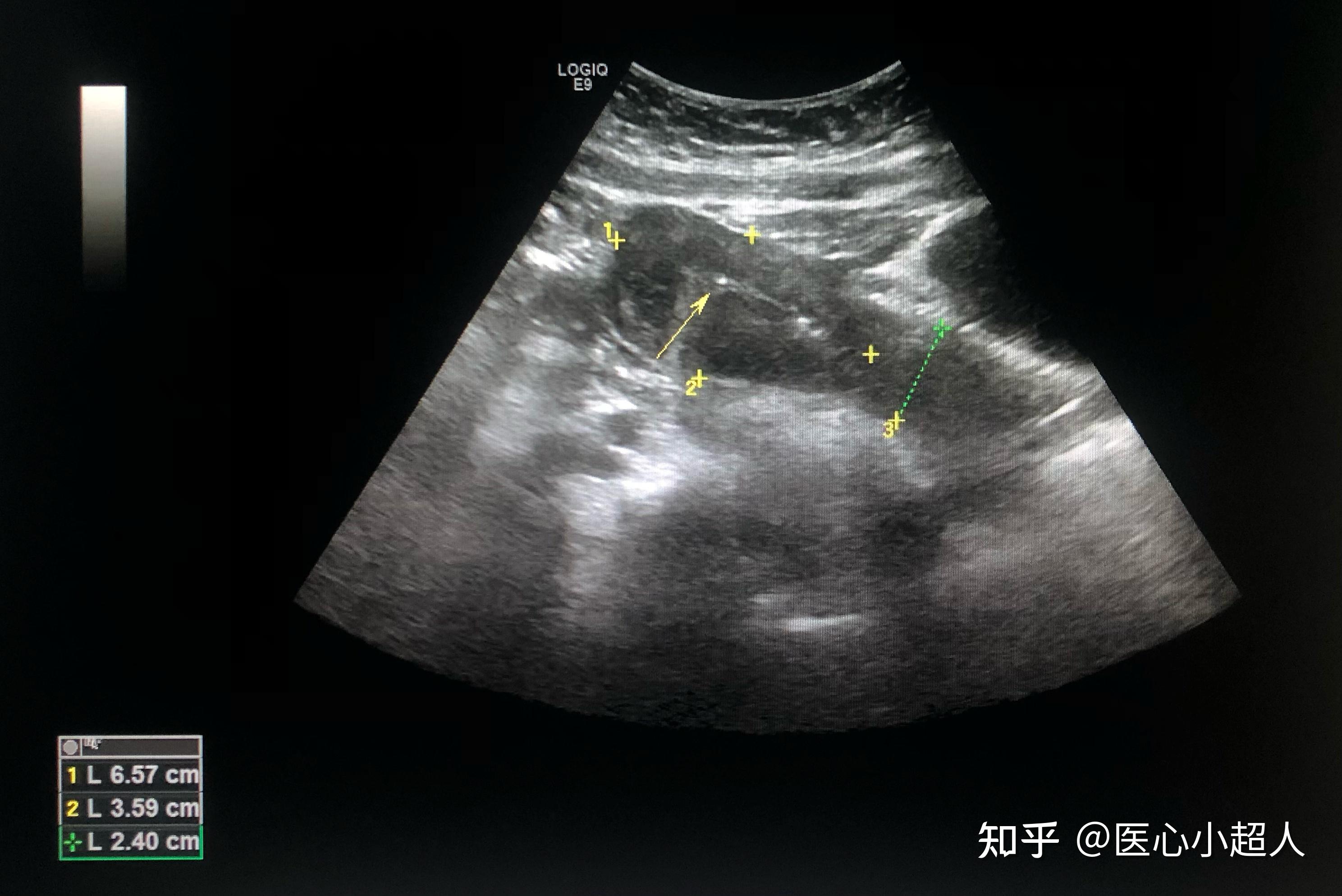 宫内节育环超声图片图片