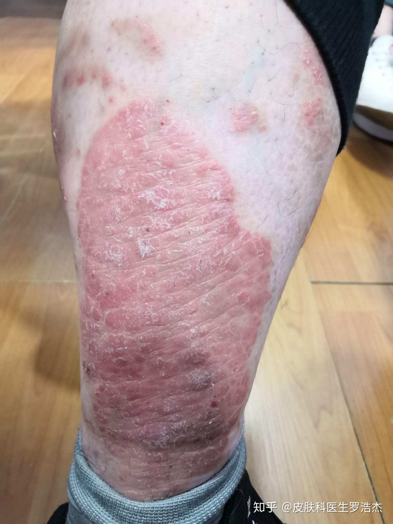 慢性皮肤病为什么这么顽固