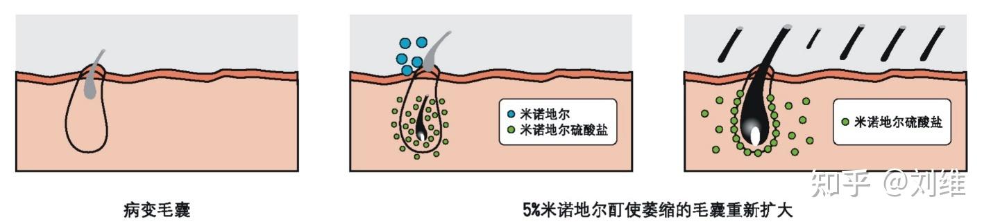 脱发是肥腻中年的专利都在买防脱产品推荐用蔓迪米诺地尔酊