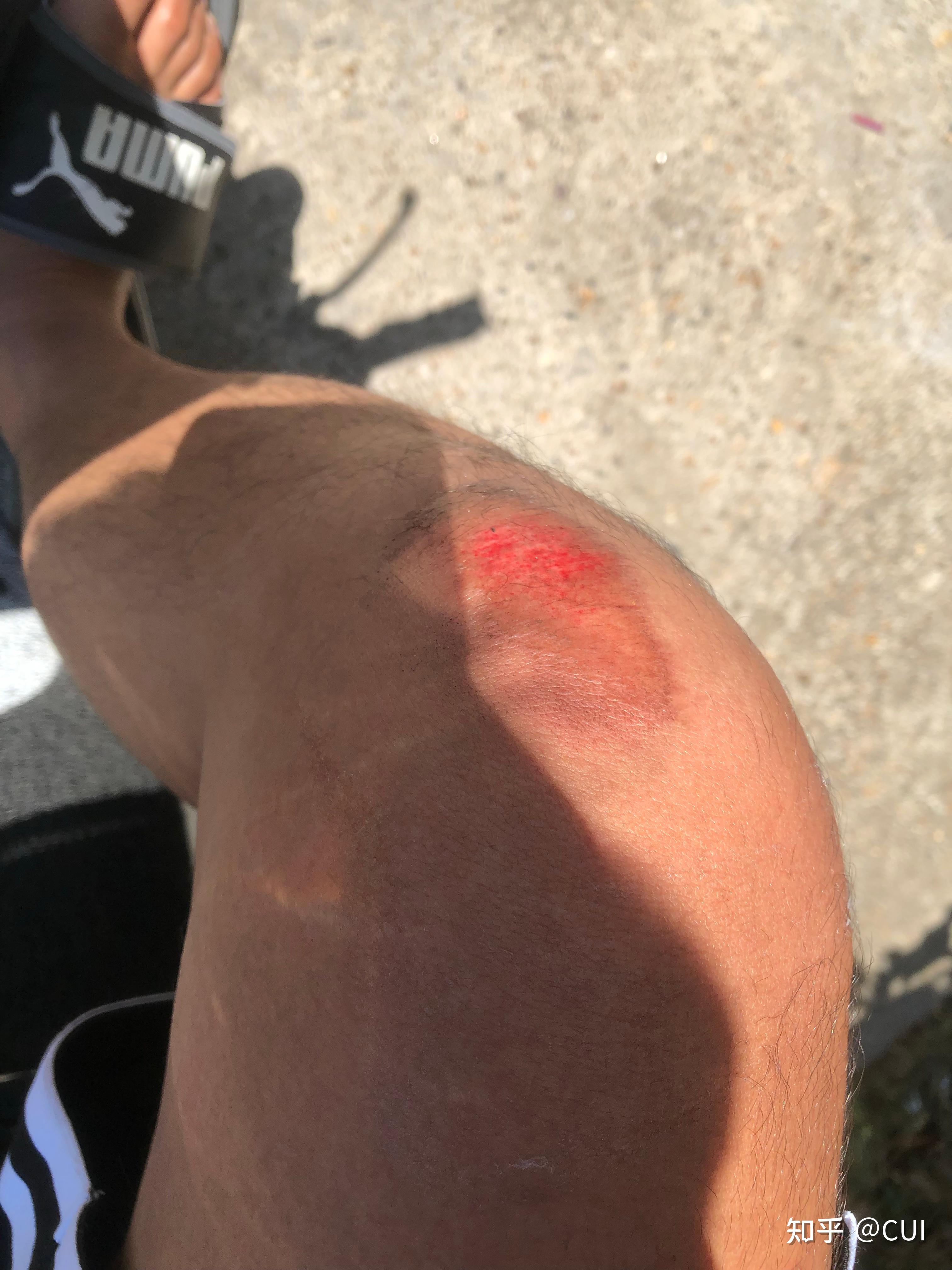 骑车摔倒腿部擦伤后,伤口愈合记录
