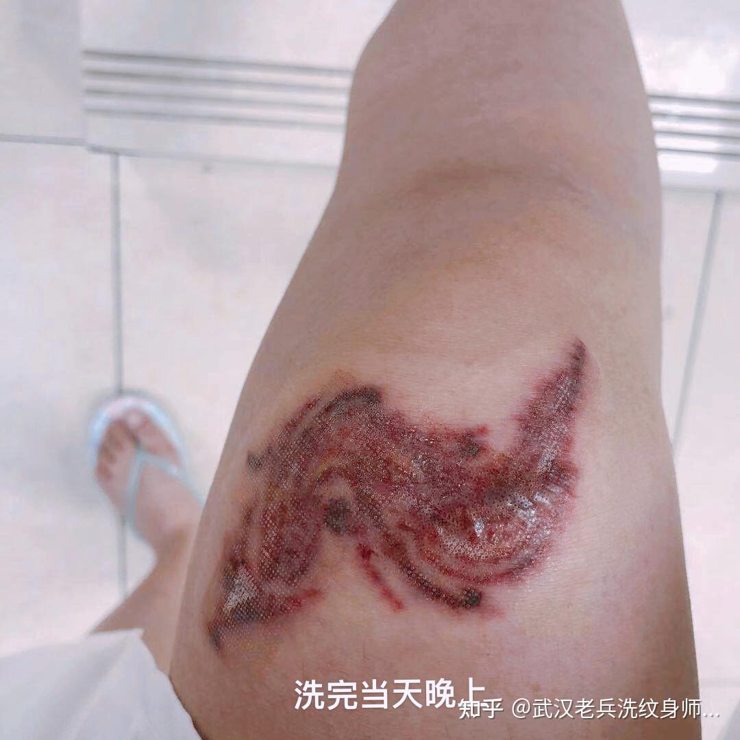 皮秒洗纹身从1-15天的恢复过程 - 知乎