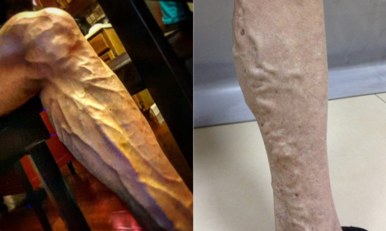 嗯,怎么说呢,只要不是静脉曲张,爆血管这个问题完全是多余的.