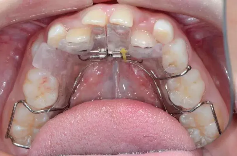 扩弓矫正会让脸变大是真的吗