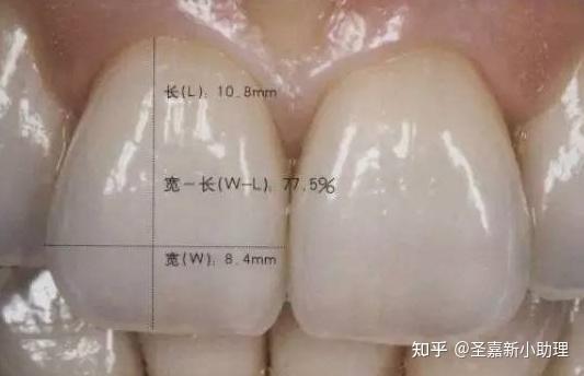 黄黑不整齐牙齿稀疏不敢张嘴修复了解一下