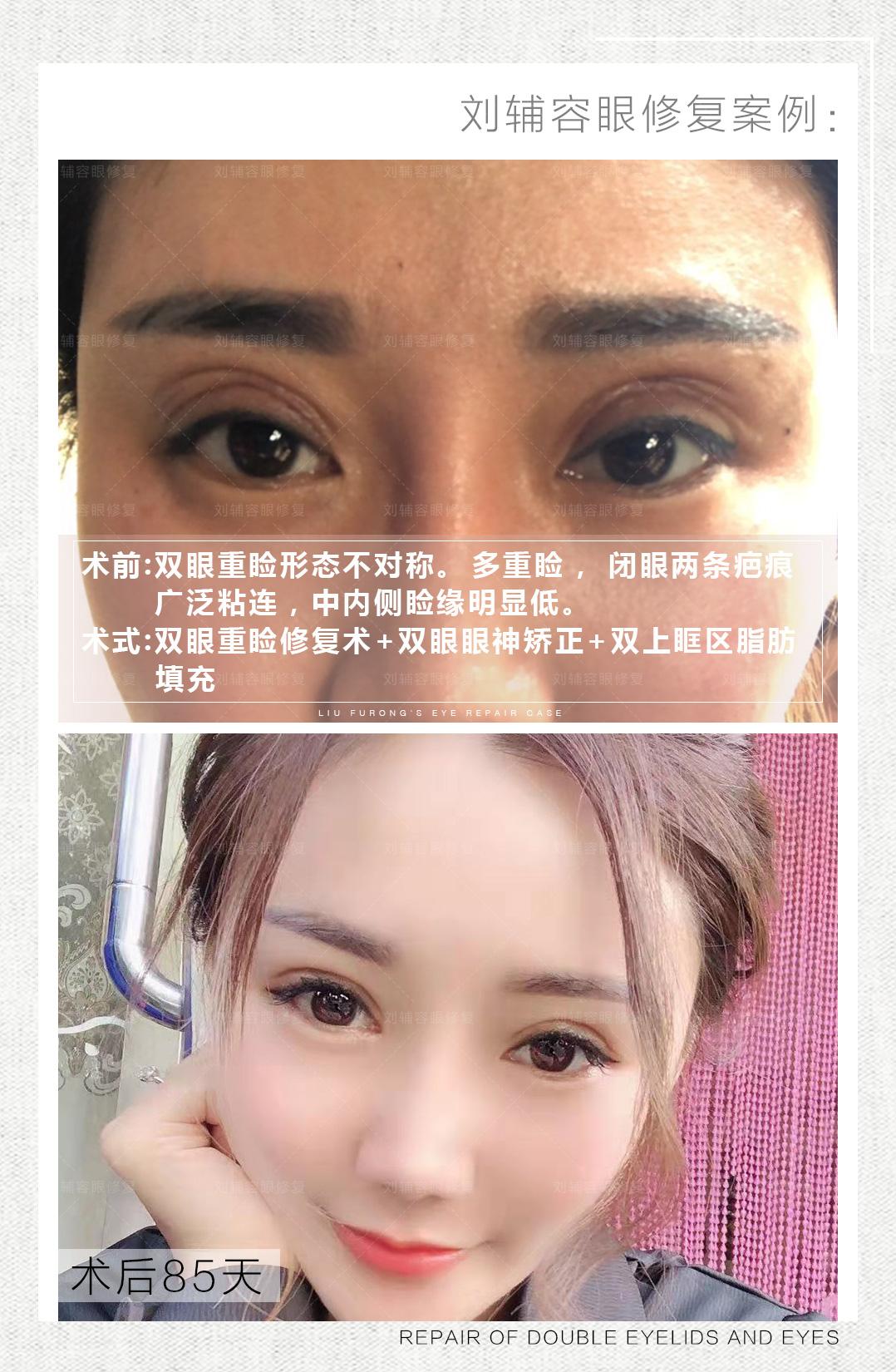 做了双眼皮反而老了十岁多重睑和粘连问题你有了解过吗