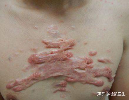 植皮增生怎么治疗?可以治疗平整吗?