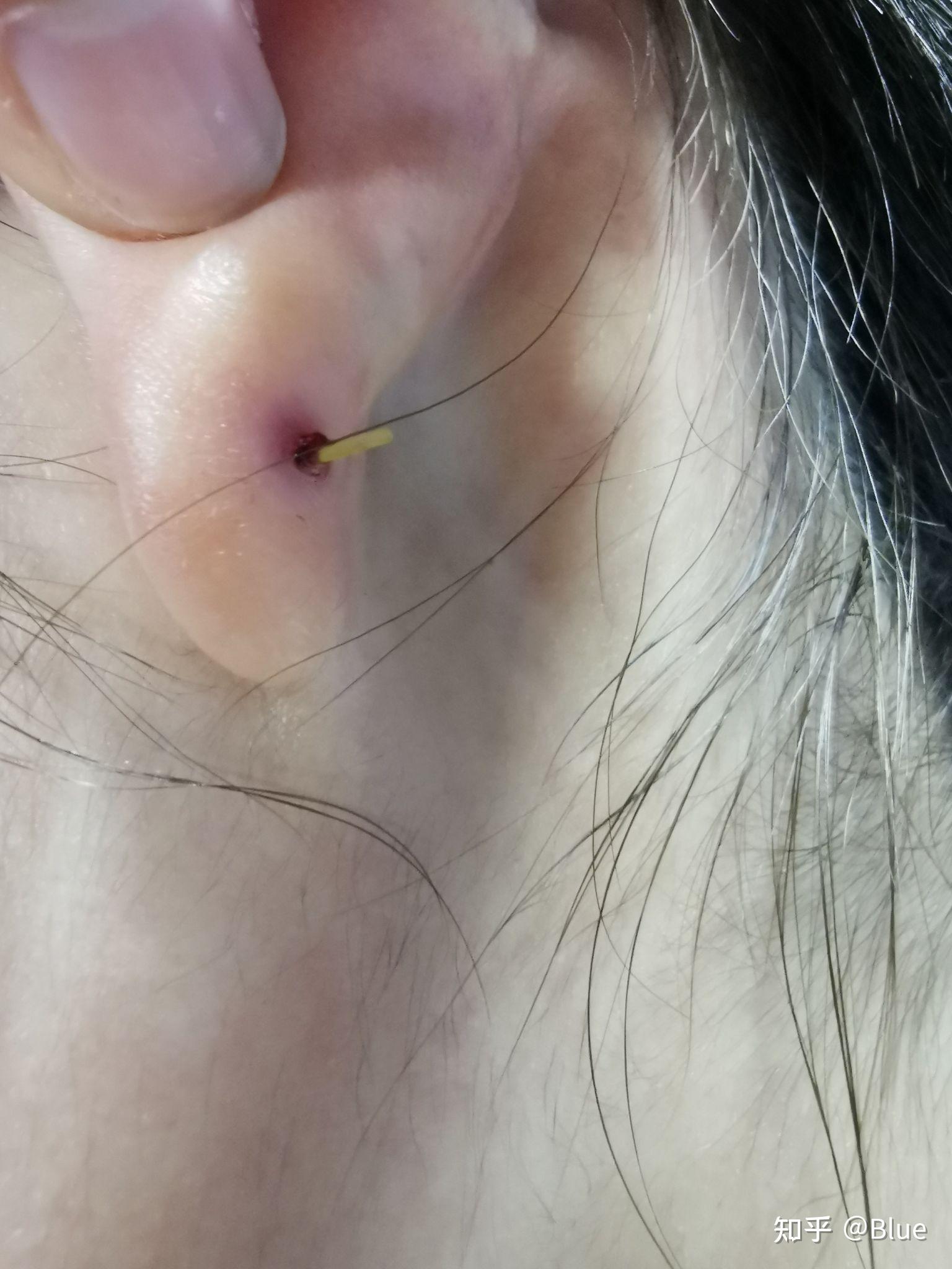 耳洞发炎红肿化脓艰辛恢复历程 